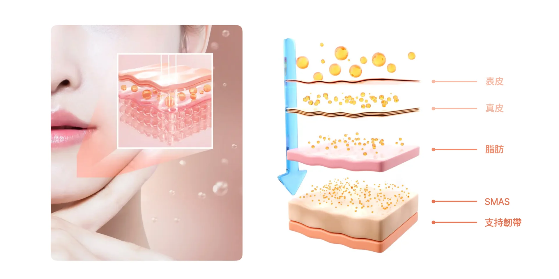 SMILE LASIK 理論說明圖片