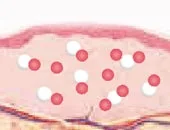 Ultracol injection