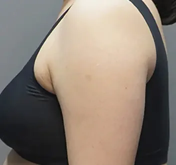 Body Injection after result