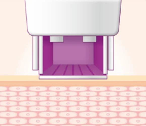 thermage technique