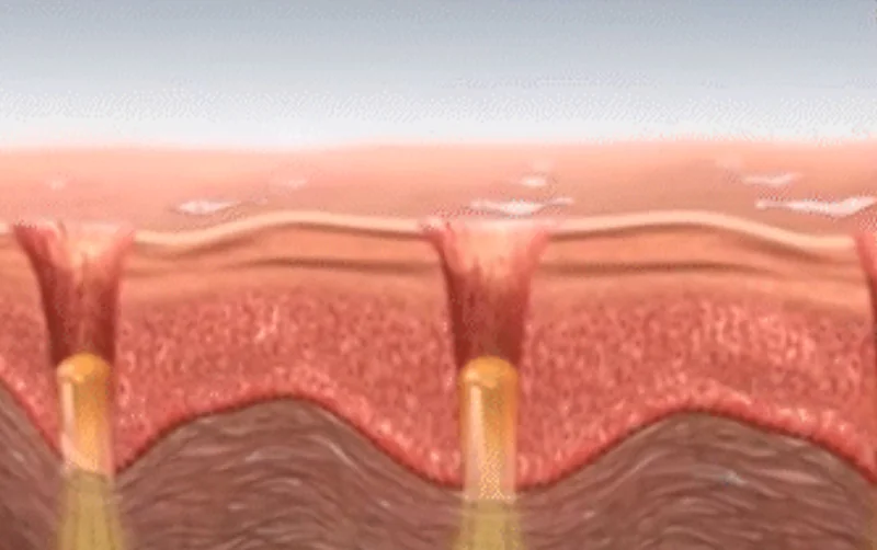Legato II treatment area 2