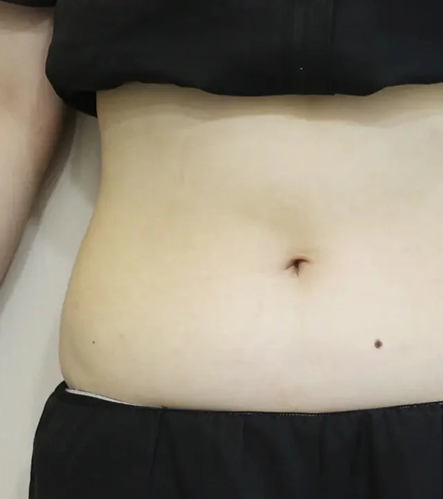 Body Lifting after result