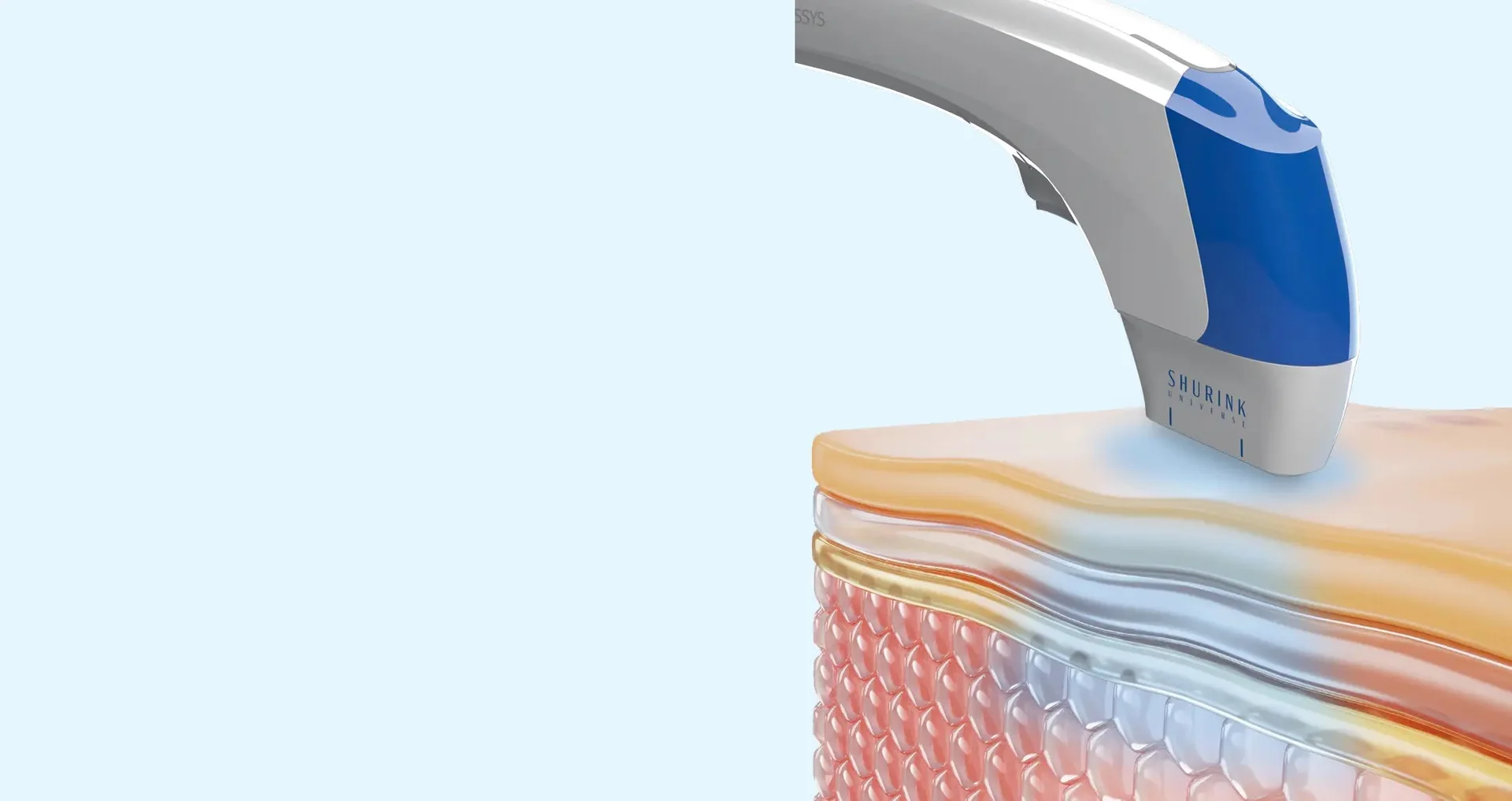 Shurink universe with ultrasono hifu