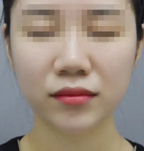 Muscle anti-wrinkle after result