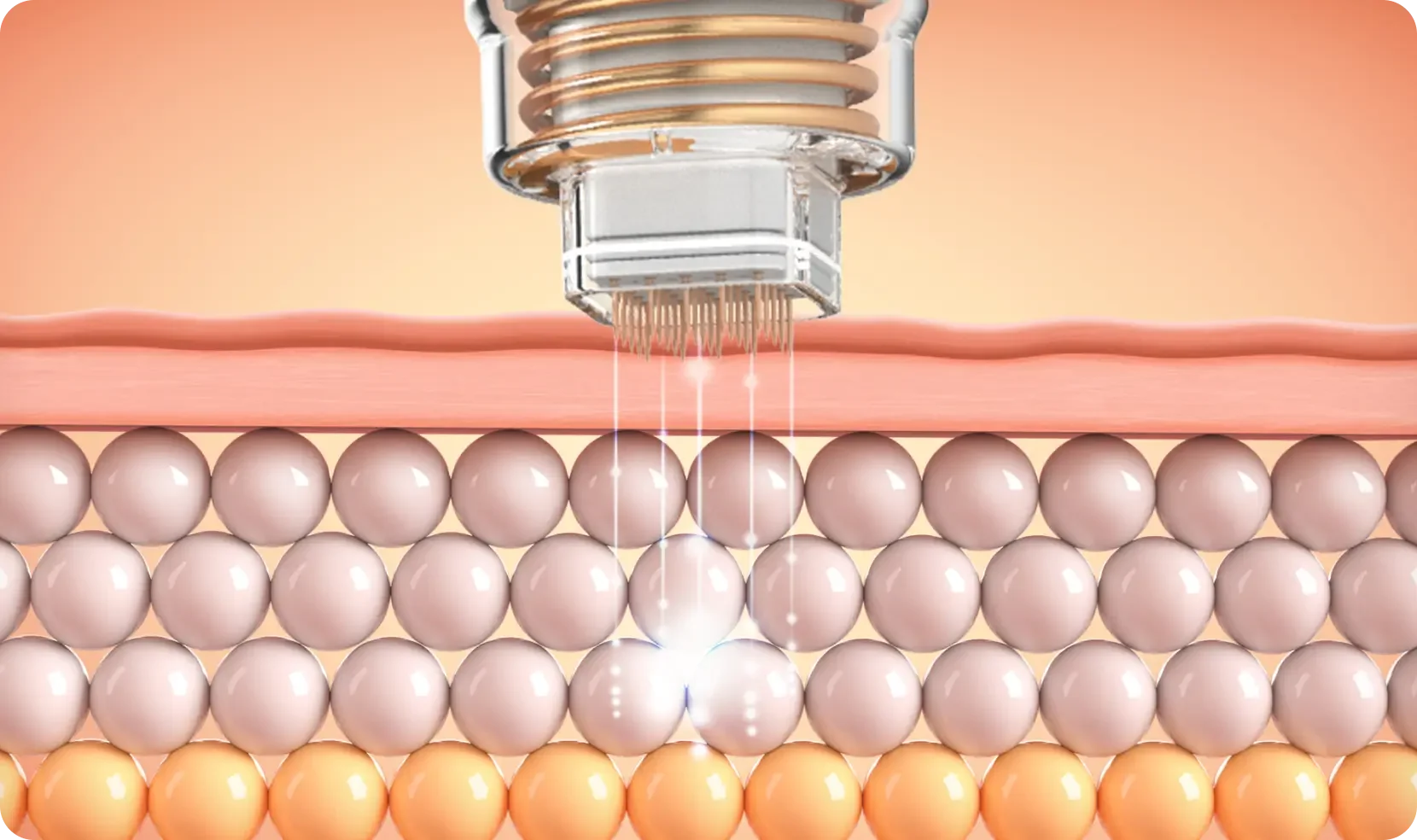 invasive Rf Potenza