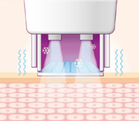 thermage technique