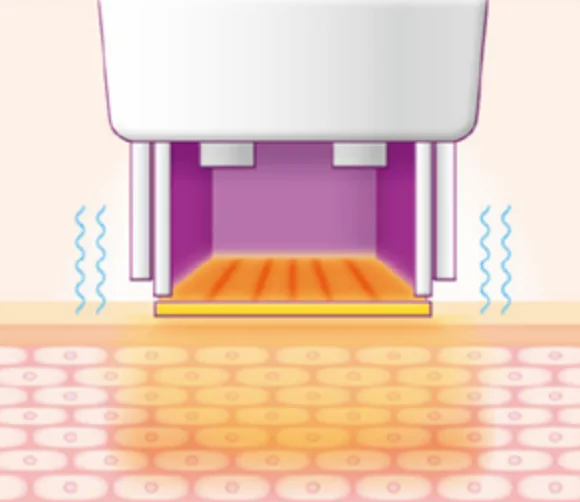 thermage technique