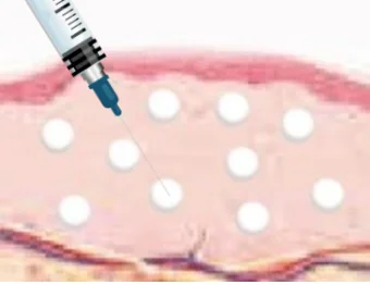 Ultracol injection