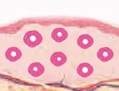Ultracol injection collagen