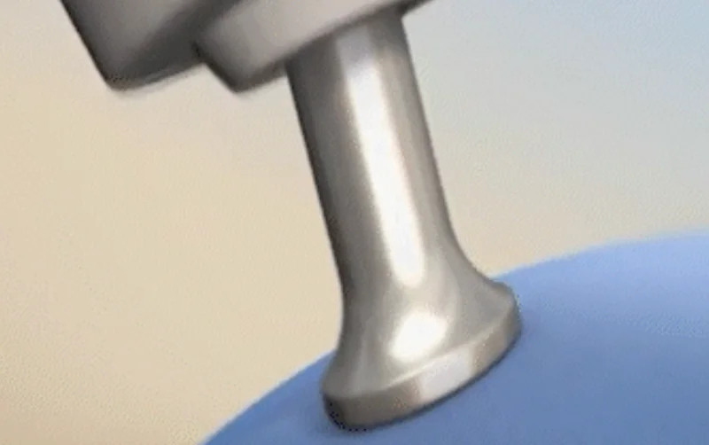 Legato II treatment area 3