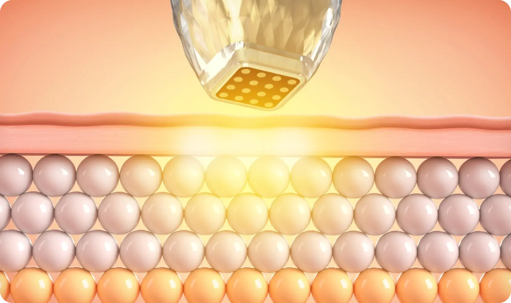 noninvasive Rf Potenza