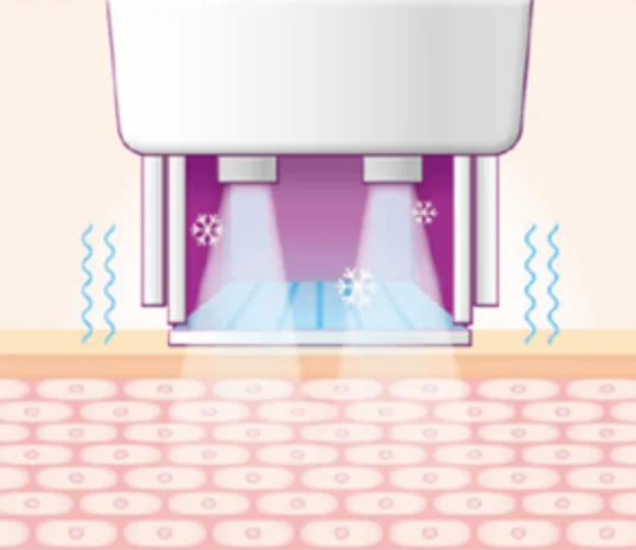 thermage technique