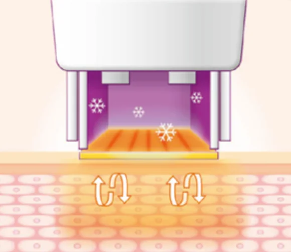 thermage technique