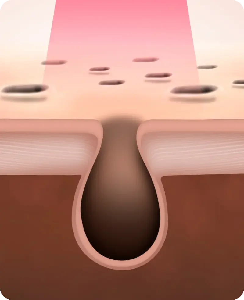 Pico toming for scars, pores and skin rejuvenation