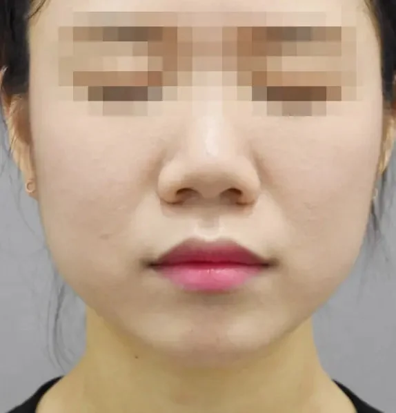 Muscle anti-wrinkle before result