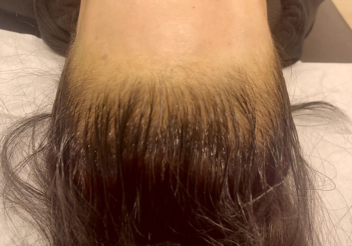 호감 헤어라인 실제 시술 사진 1 — 이마 머리선 부위만